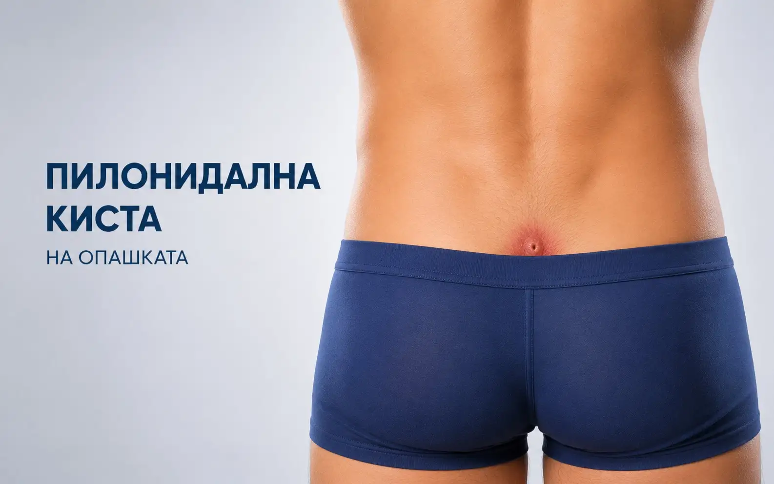 Пилонидална киста на опашката
